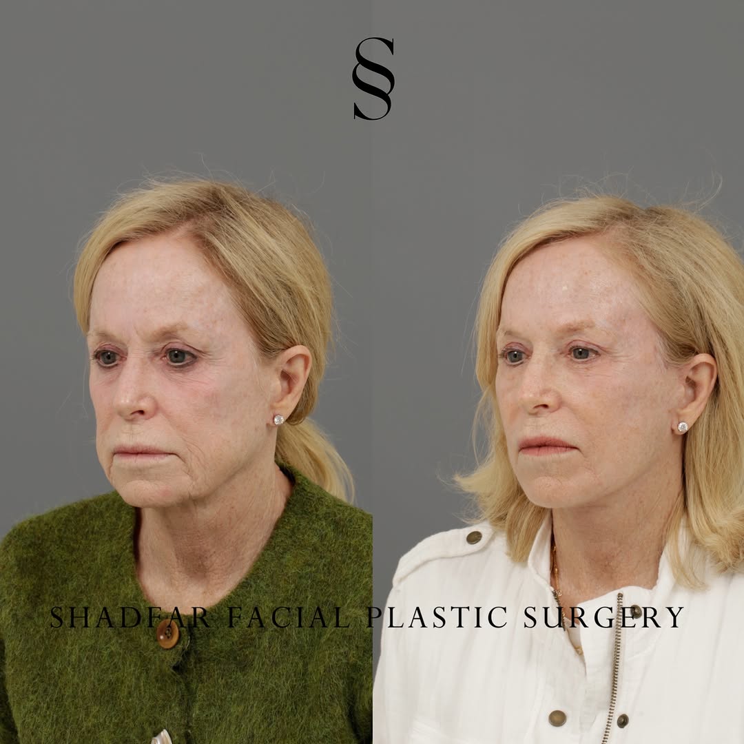 Instagram post by Dr. Scott Shadfar: Take your time and study the structural refinements of her Revision Deep Plane Facelift and Fat Grafting. When you evaluate the three-quarte…
