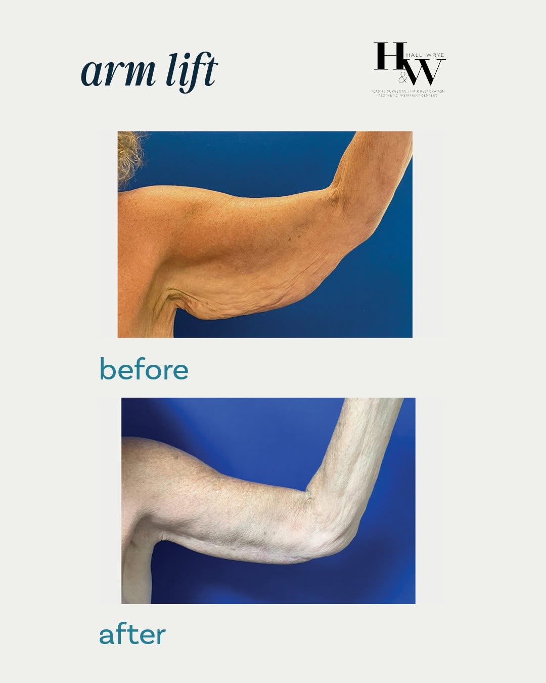 Instagram post by Dr. Scott W. Wrye: Arm lifts are an incredible procedure that can help give your arms a more toned look. Brachioplasties target the removal of hanging tissues …