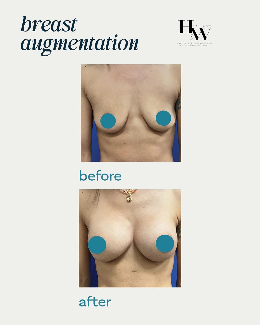 Instagram post by Dr. Scott W. Wrye: This before & after of a breast augmentation is a great example of why we do what we do! At Hall & Wrye, patients receive one-on-one guidanc…