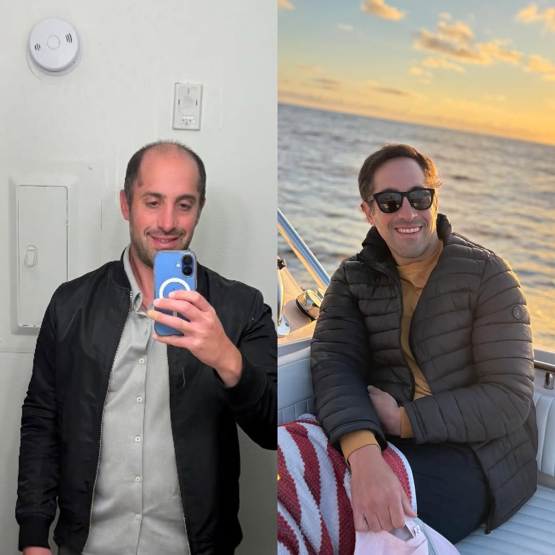 Instagram post by Dr. Sean Behnam: 5,300 graft transplant transformation. What makes this case so unique is that he had a very weak donor hair. Dr Sean used various techniques…