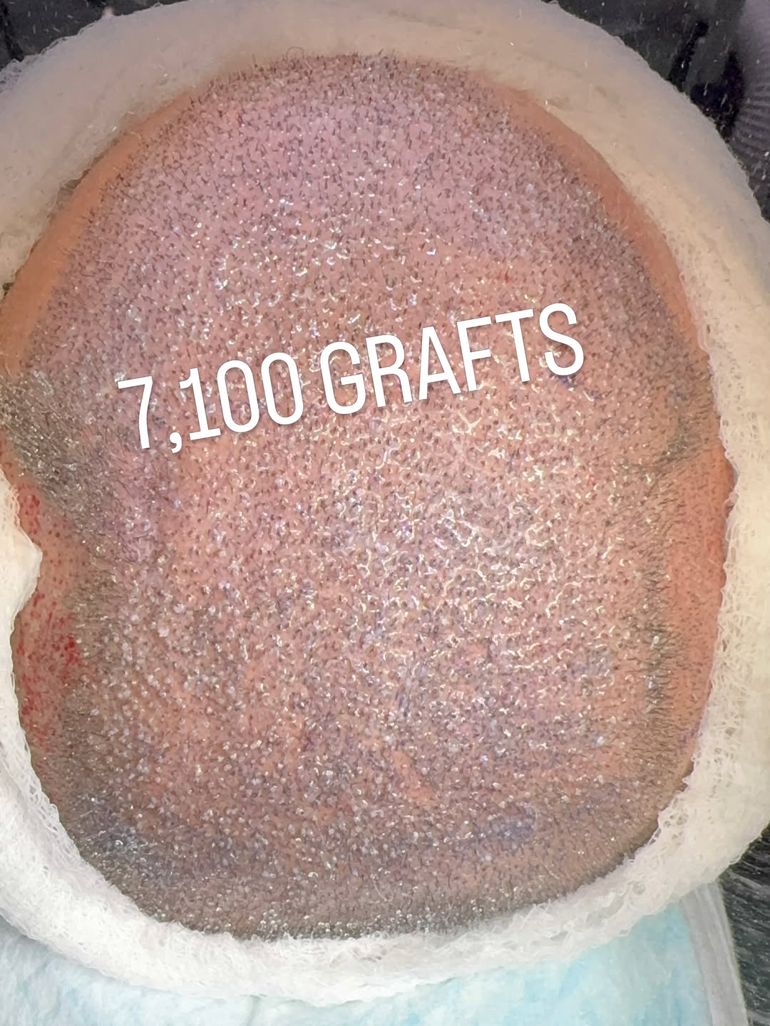 Instagram post by Dr. Sean Behnam: 7,100 grafts FUE. This was one of the biggest case sessions!
