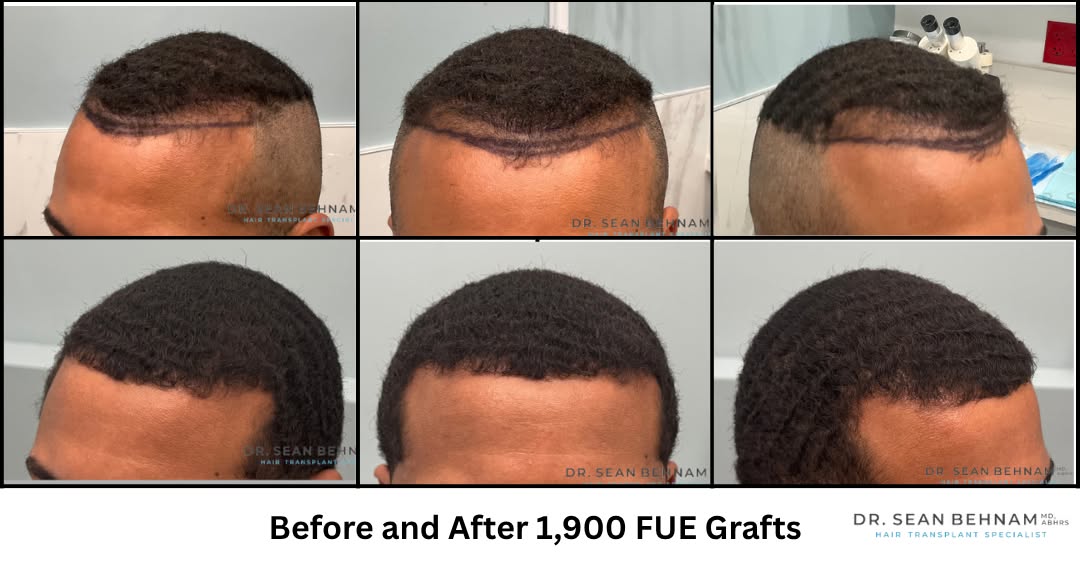Instagram post by Dr. Sean Behnam: Curly hair transplant at the hairline performed by Dr. Sean Behnam #HairTransplant #FUE #FUEHairTransplant #HairRestoration #HairTransplantR…