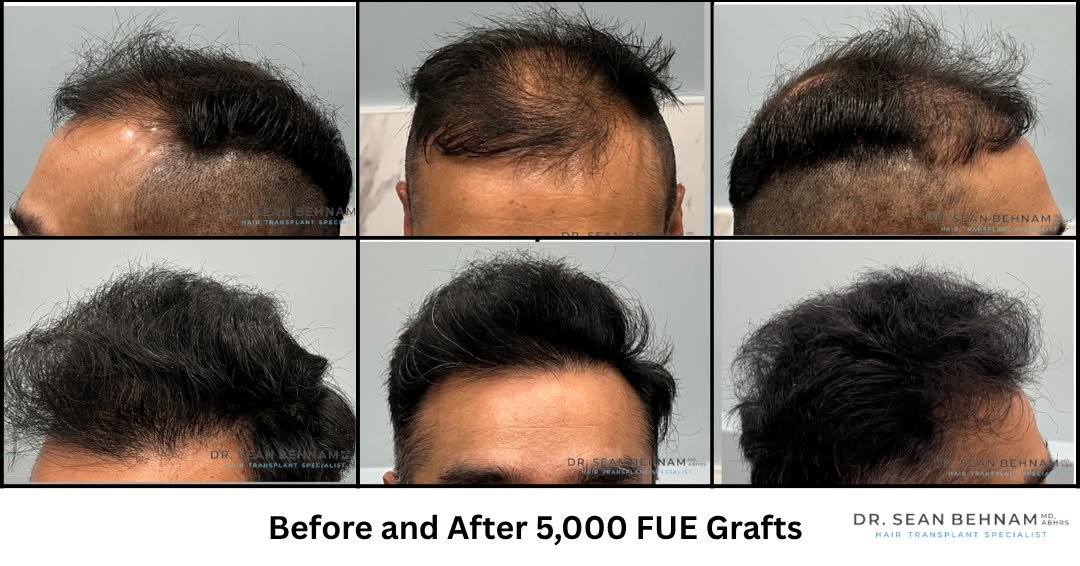 Instagram post by Dr. Sean Behnam: After 5,000 Grafts from the midscalp to the hairline by Dr. Sean Behnam #HairTransplant #FUE #FUEHairTransplant #HairRestoration #HairTransp…