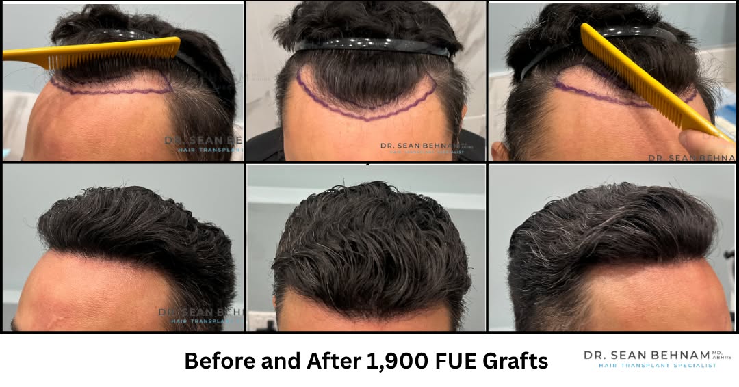 Instagram post by Dr. Sean Behnam: 1,900 FUE Grafts at the hairline by Dr. Sean Behnam #HairTransplant #FUE #FUEHairTransplant #HairRestoration #HairTransplantResults