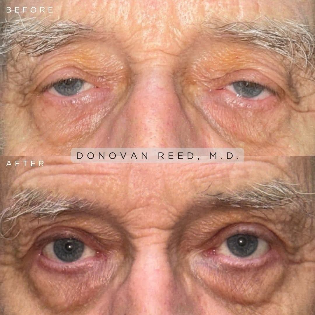 Instagram post by Dr. Sean M. Blaydon: Lid lifting surgery (ptosis repair) isn’t strictly cosmetic, and it’s certainly not just for women. Eyelid surgery can be about far more tha…