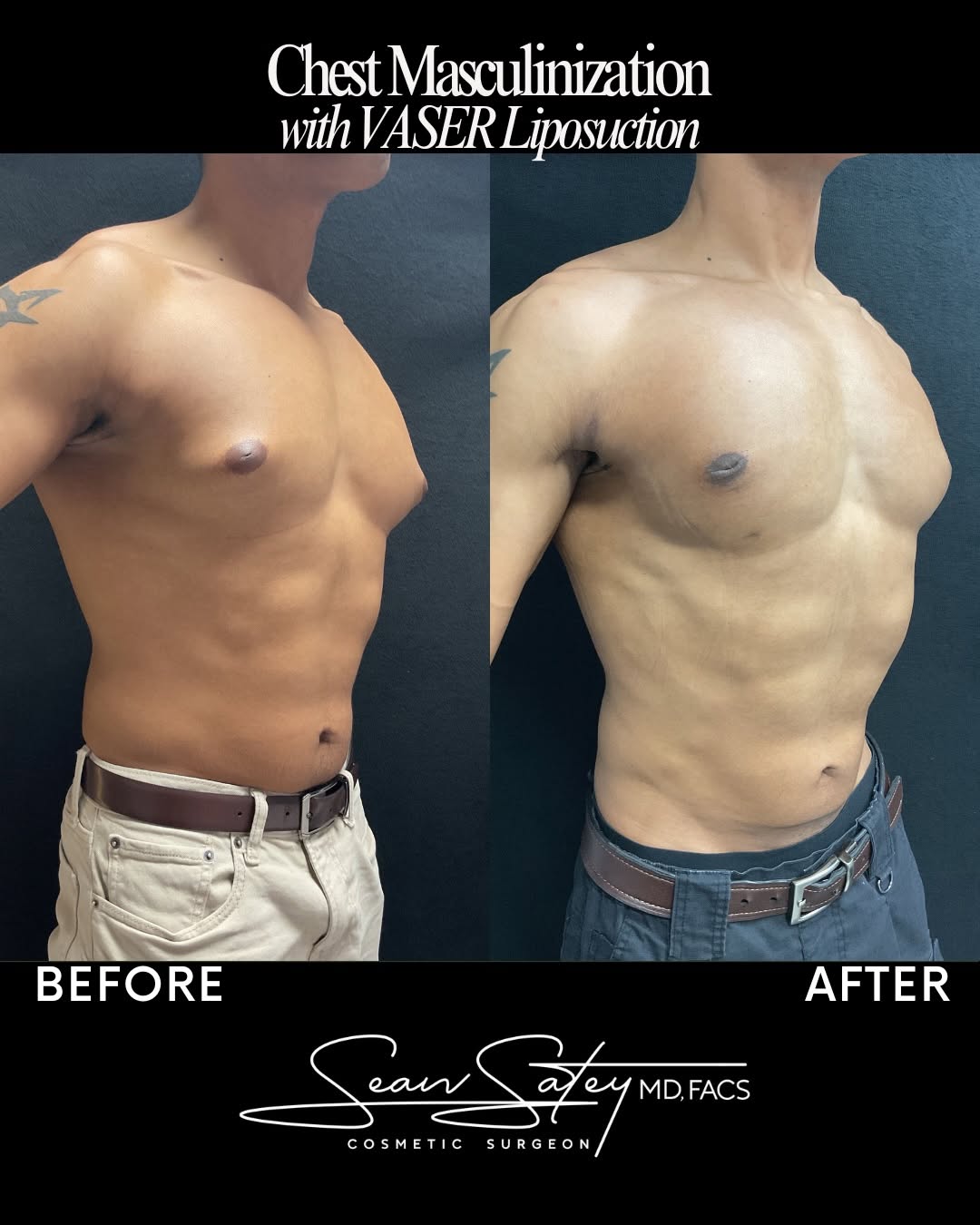 Instagram post by Dr. Sean Satey: Masculine Definition. Precision Sculpting. Real Transformation. 💪 This 27-year-old patient underwent VASER Liposuction with Dr. Sean Satey …