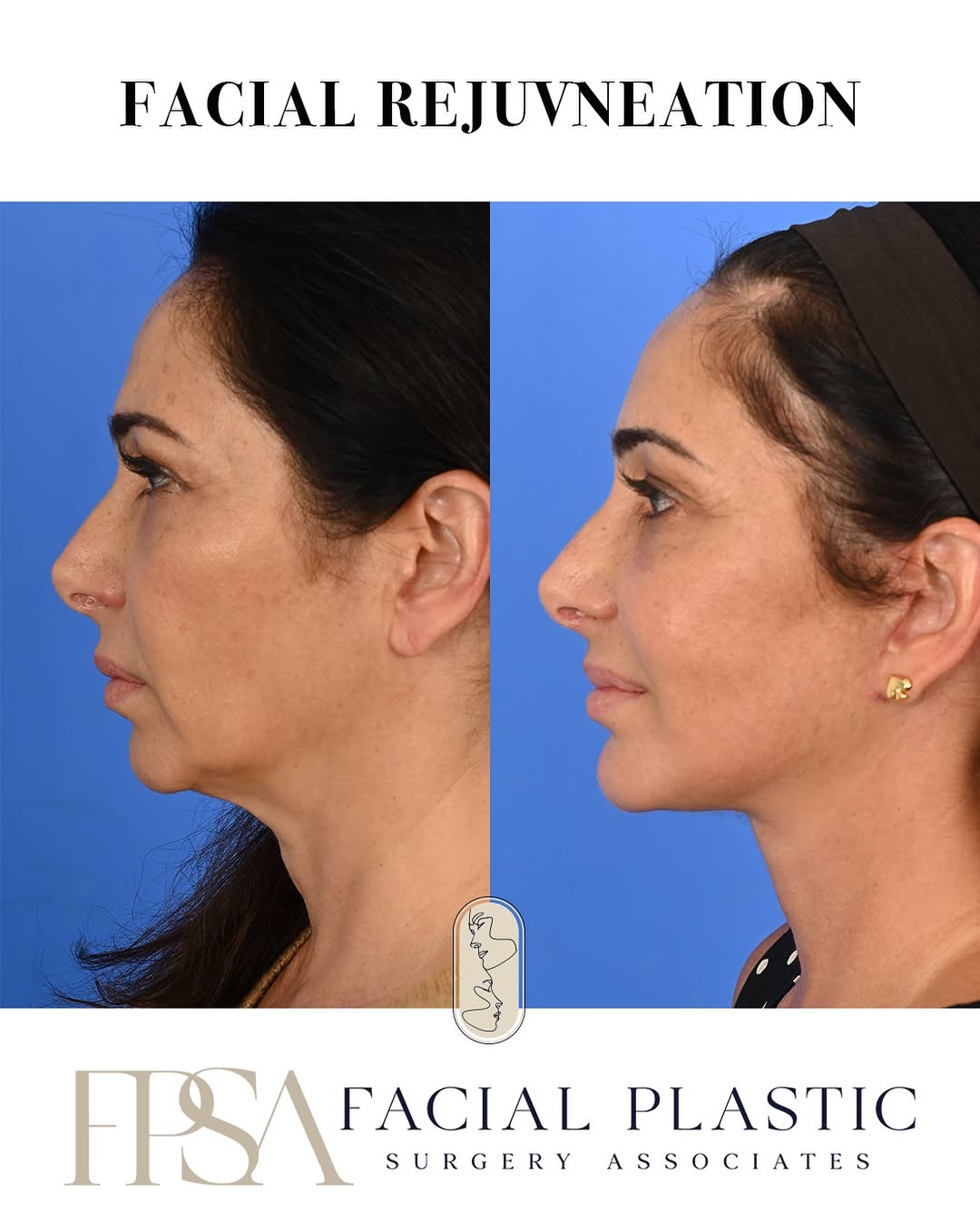 Instagram post by Dr. Sean W. Delaney: This stunning patient in her 50s is shown 3 months after facial rejuvenation with an endoscopic brow lift, extended deep plane facelift, and…