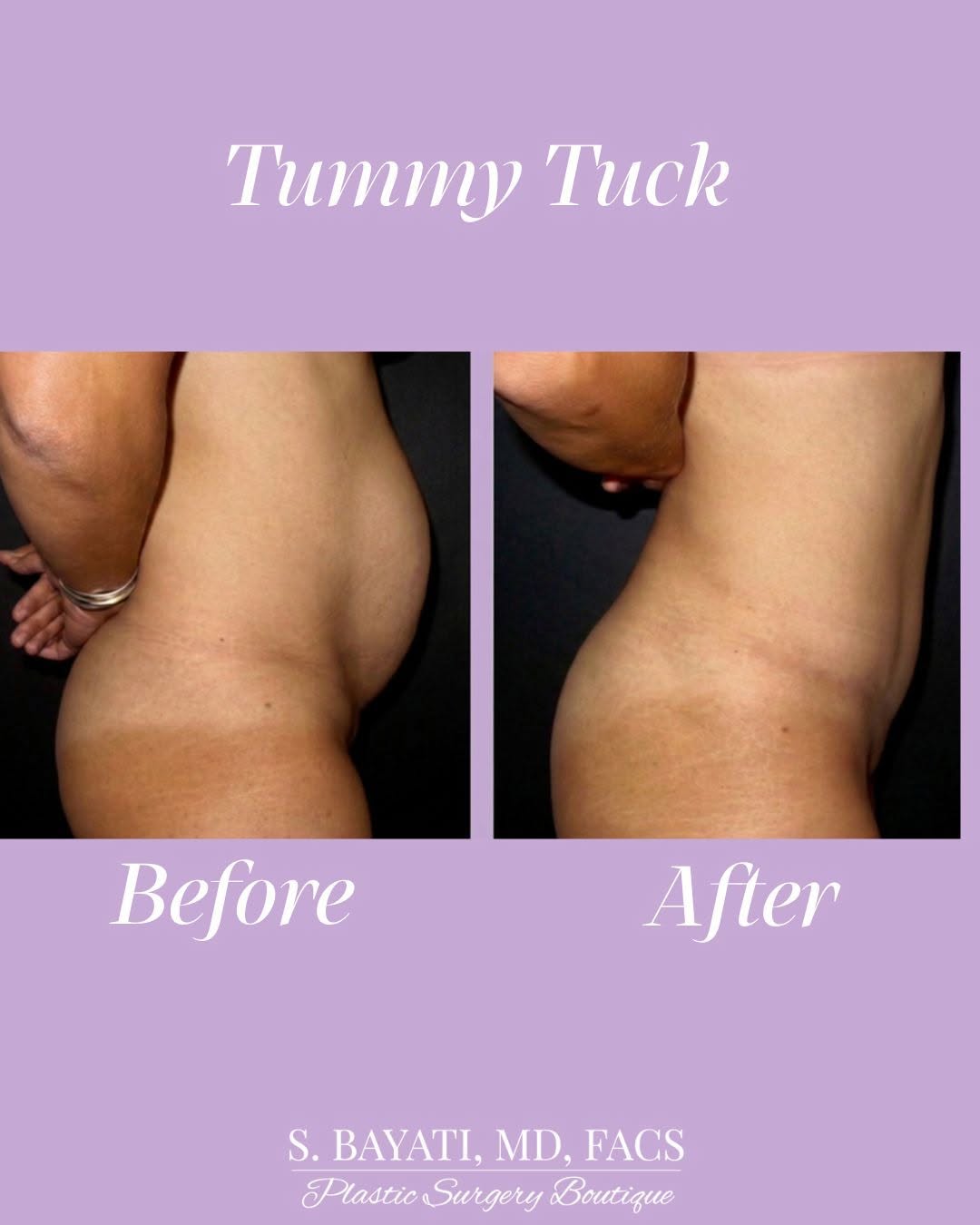 Instagram post by Dr. Semira Bayati: ✨ A flatter, firmer, more sculpted abdomen—beautifully tailored to your unique goals. A tummy tuck can remove excess skin, tighten separated…