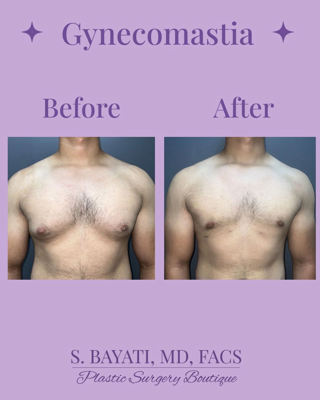 Instagram post by Dr. Semira Bayati: A more defined chest. A renewed sense of confidence. ✨ Gynecomastia correction is designed to reduce excess breast tissue and create a flatt…