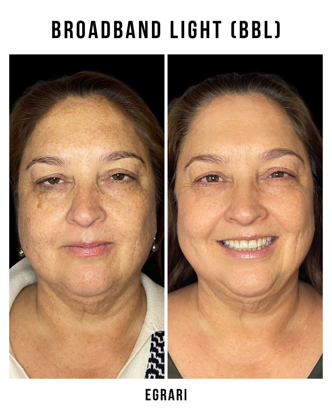 Instagram post by Dr. Sepehr Egrari: 𝘽𝙀𝙁𝙊𝙍𝙀+𝘼𝙁𝙏𝙀𝙍 📷 BBL laser before and after sun damage + uneven pigmentation After 2 BroadBand Light treatments, we’re seeing vis…
