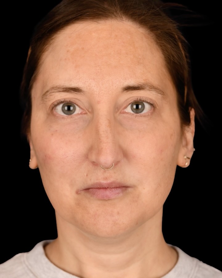 Instagram post by Dr. Sepehr Egrari: 𝘽𝙀𝙁𝙊𝙍𝙀+𝘼𝙁𝙏𝙀𝙍 📷 Cheek and under-eye filler before and after 1 mL of Juvéderm Voluma was used in the cheeks and 2 mL of Juvéderm …