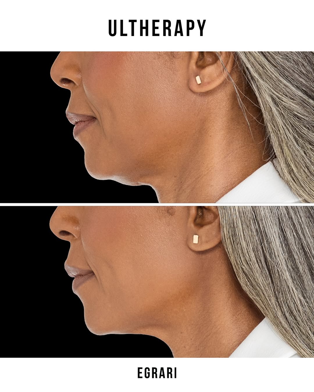 Instagram post by Dr. Sepehr Egrari: 𝘽𝙀𝙁𝙊𝙍𝙀+𝘼𝙁𝙏𝙀𝙍 📷 Ultherapy before and after The beauty of Ultherapy is that a single treatment can improve skin laxity. The under…