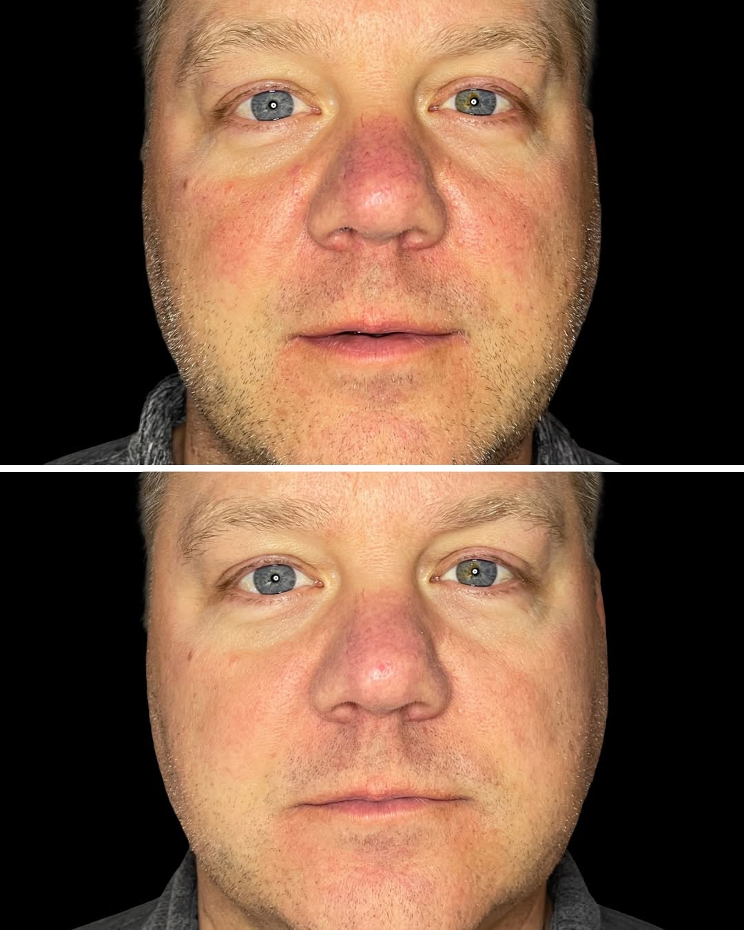 Instagram post by Dr. Sepehr Egrari: 𝘽𝙀𝙁𝙊𝙍𝙀+𝘼𝙁𝙏𝙀𝙍 📷 BBL before and after | nose + cheeks Results after 3 BBL treatments targeting visible redness across the nose an…