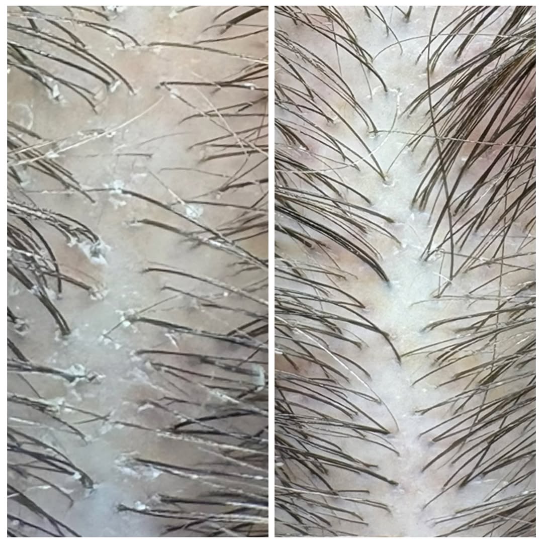 Instagram post by Dr. Seth Eberlin: ✨ Healthy Hair Starts at the Scalp. ✨ Your scalp is the foundation for healthy-looking hair—and it deserves just as much attention as your s…