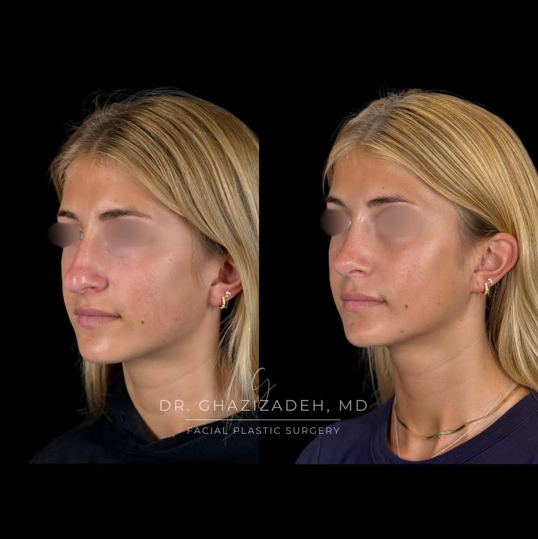 Instagram post by Dr. Shabnam Ghazizadeh: Teen rhinoplasty 3 month before & after ✨⭐️ A delicate nose to match her delicate features! This patient had a dorsal hump and strong lower …