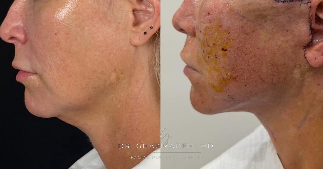 Instagram post by Dr. Shabnam Ghazizadeh: One DAY after deep plane facelift, neck lift, CO2 laser resurfacing. Sometimes I dont like to share these immediate photos, but I think they…