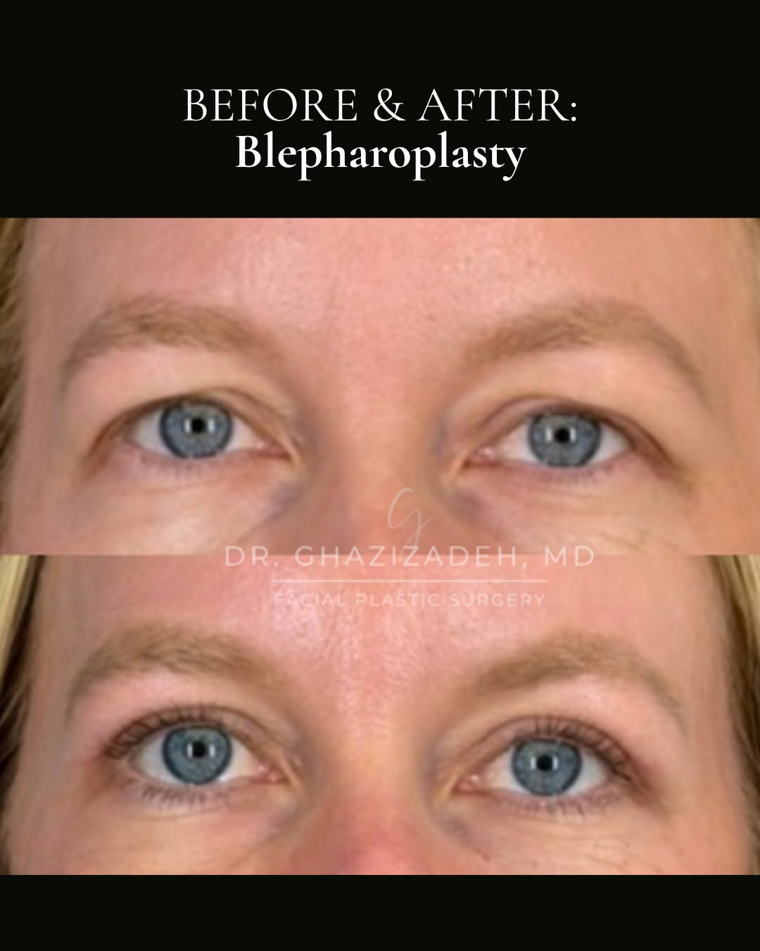 Instagram post by Dr. Shabnam Ghazizadeh: By addressing excess upper eyelid skin and hooding, a blepharoplasty creates a more rested appearance while preserving the natural shape and…