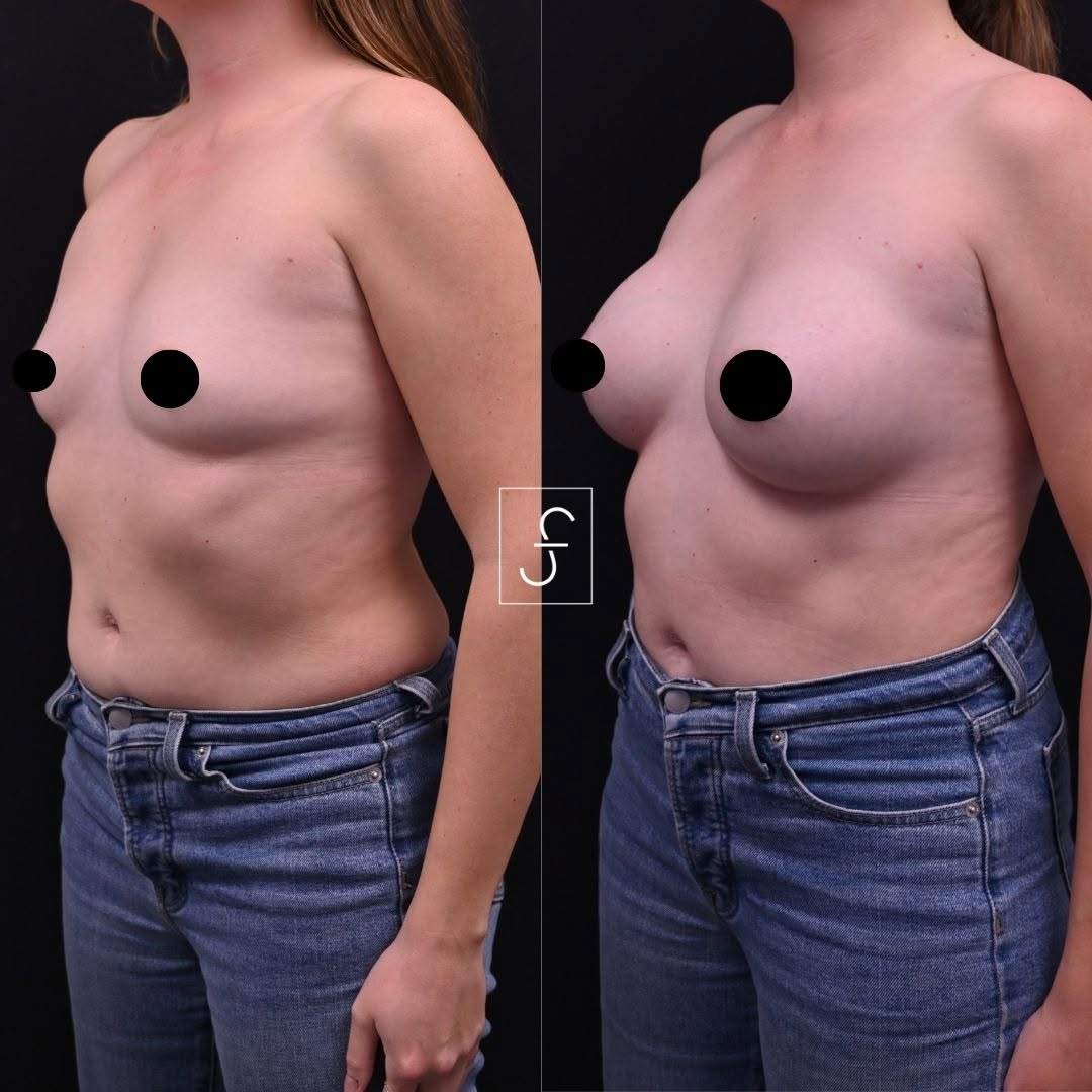 Instagram post by Dr. Shahin Fazilat: Confidence looks good on her. 🌸 Breast augmentation with Dr. Fazilat is never about a dramatic transformation — it is about restoring confi…
