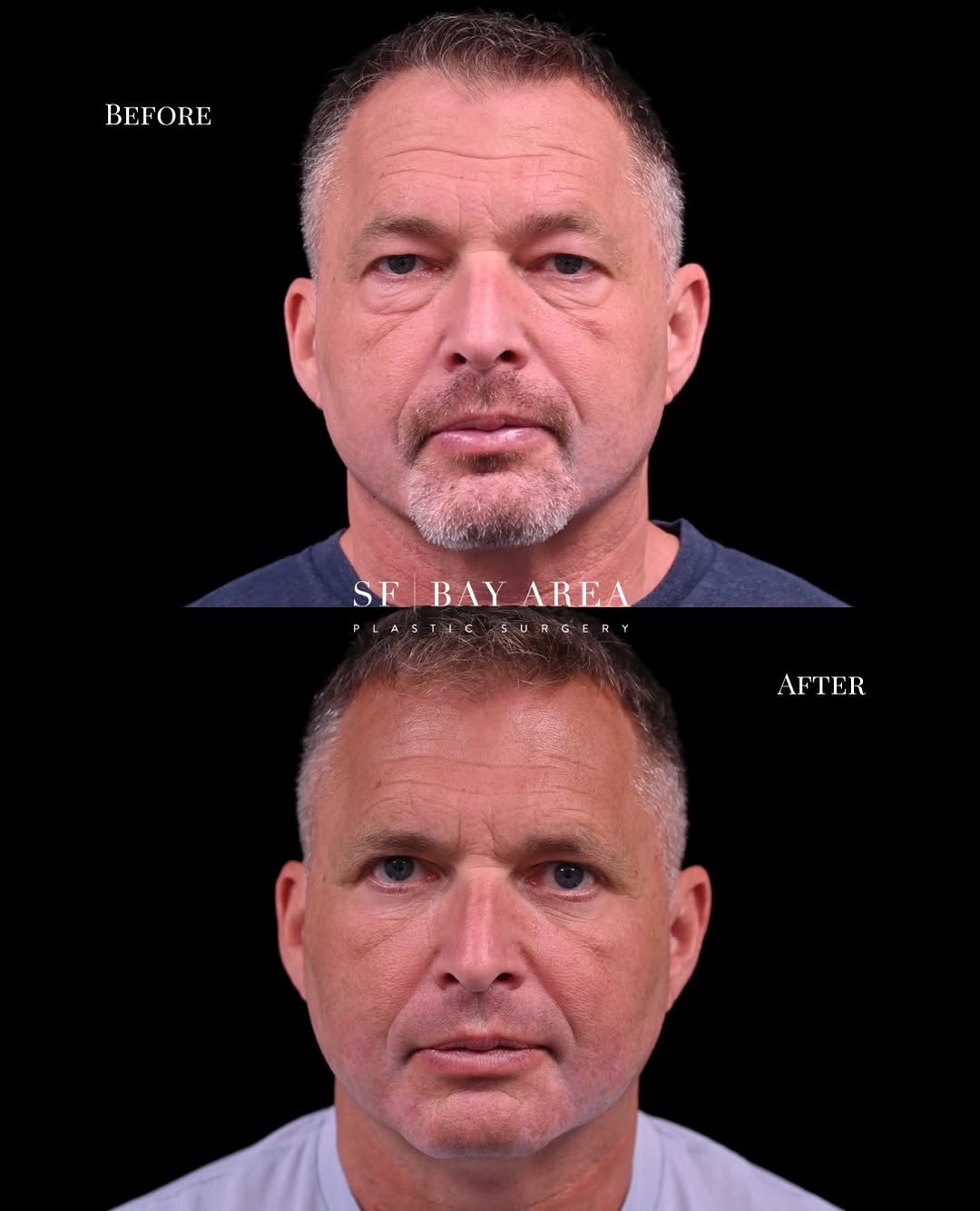 Instagram post by Dr. Shahin Fazilat: Before & After: Lower and Upper Blepharoplasty 👀 Tired, puffy under eyes can make you look more exhausted than you feel, even after a full …