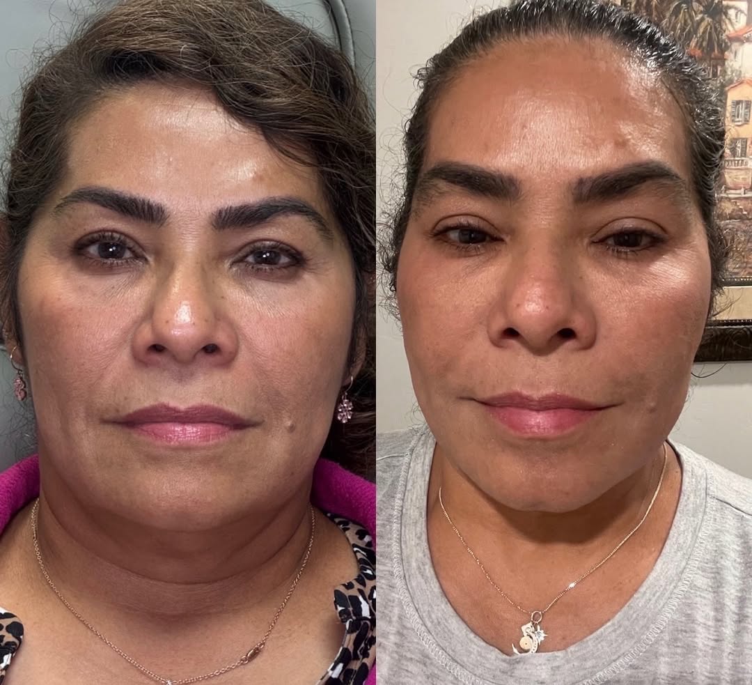 Instagram post by Dr. Shannon Maltais, N: This is what we mean when we say results you can see. 👏🏼 Before and after from Endolift The best aesthetic results aren’t about changing y…