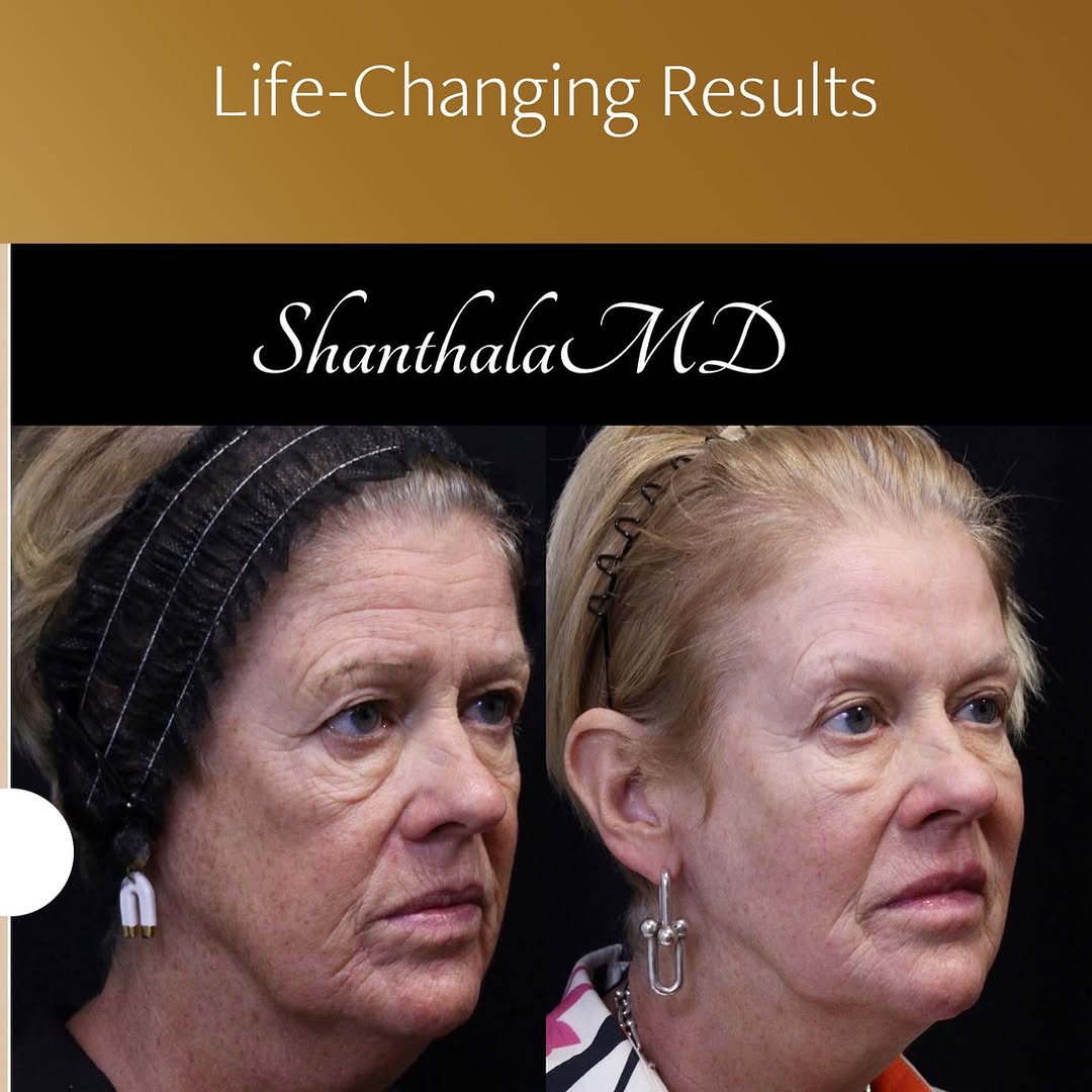 Instagram post by Dr. Shanthala Shivananjappa: Achieving a Lifted, Rejuvenated Look—No Surgery Needed Let’s set the record straight: You don’t need surgery to achieve a lifted, youthful a…