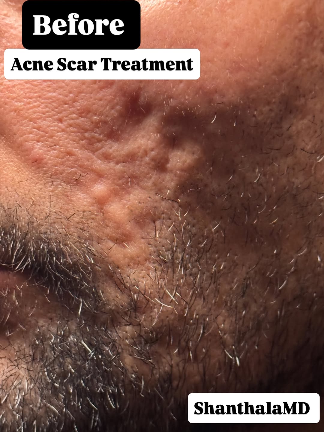 Instagram post by Dr. Shanthala Shivananjappa: Severe atrophic scars are architectural problems, not just surface problems. Case: Severe atrophic acne scarring with significant volume dep…