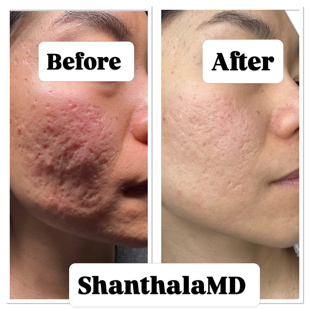 Instagram post by Dr. Shanthala Shivananjappa: Advanced Acne Scar Remodeling During almost every acne scar consultation, patients tell me the same thing: “I have realistic expectations. I…