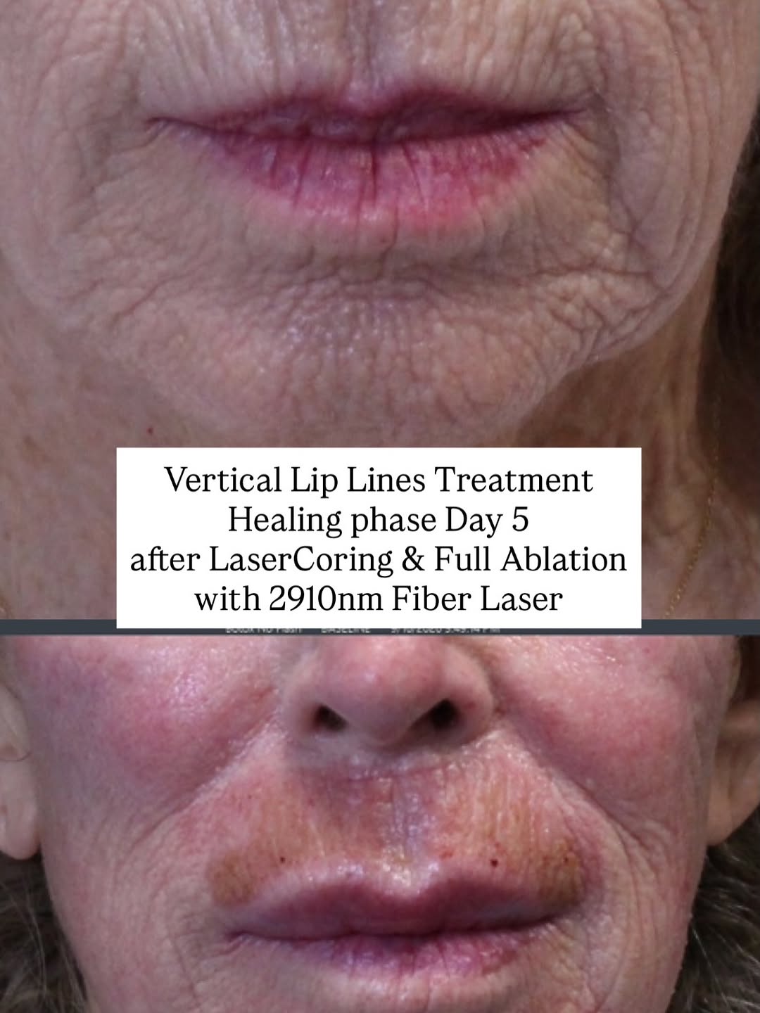 Instagram post by Dr. Shanthala Shivananjappa: Vertical upper lip lines are not all treated the same way ✅ Some lines are mainly caused by muscle movement That may be where a neuromodulat…