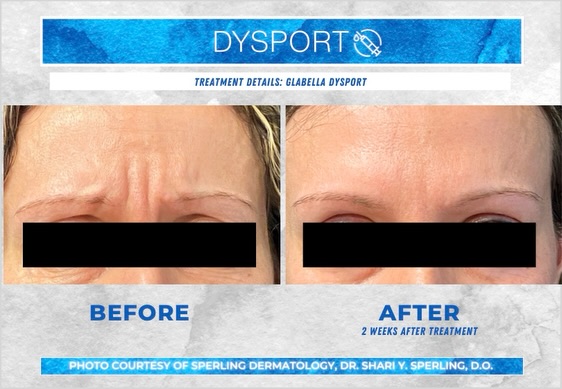 Instagram post by Dr. Shari Sperling, DO, FAOCD, FAAD: The best injectable results are the ones no one can quite put their finger on🤍 This full-face Dysport treatment can do so much more than so…
