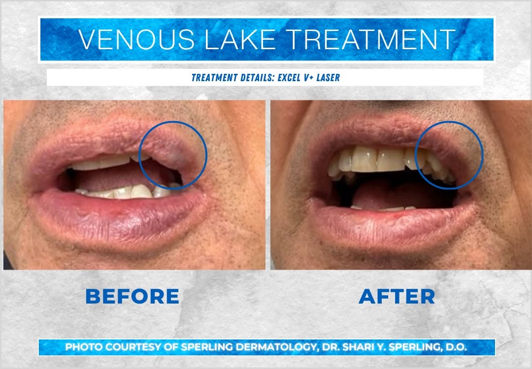 Instagram post by Dr. Shari Sperling, DO, FAOCD, FAAD: Bye-bye, venous lake 👋💋 This before & after shows the results of treating a venous lake with the Cutera laser. A venous lake is a harmless…