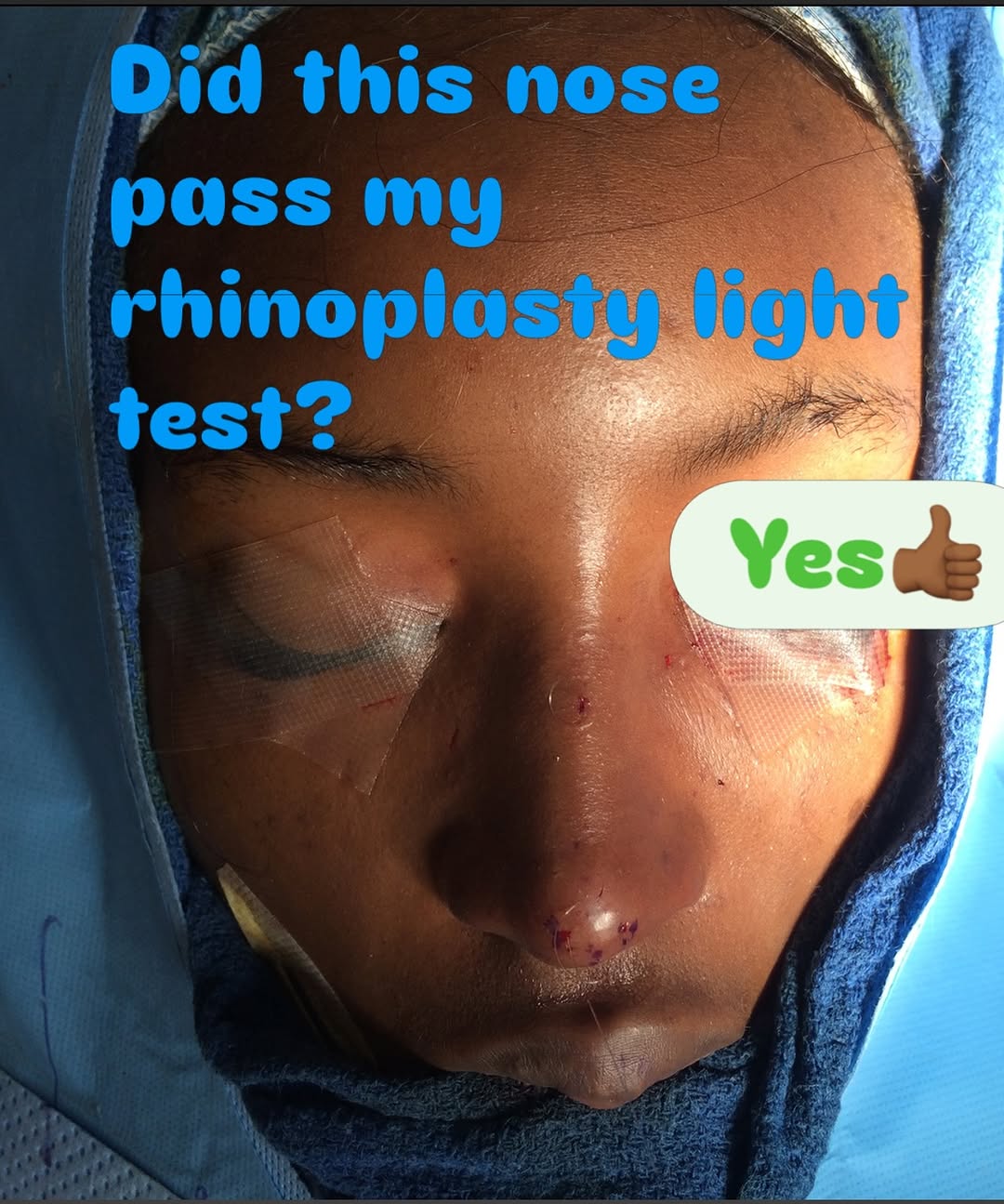Instagram post by Dr. Shaun C. Desai: Did this nose pass my rhinoplasty light test?” Yes. ✅ At the end of every rhinoplasty, before I am satisfied with the result, I walk around …
