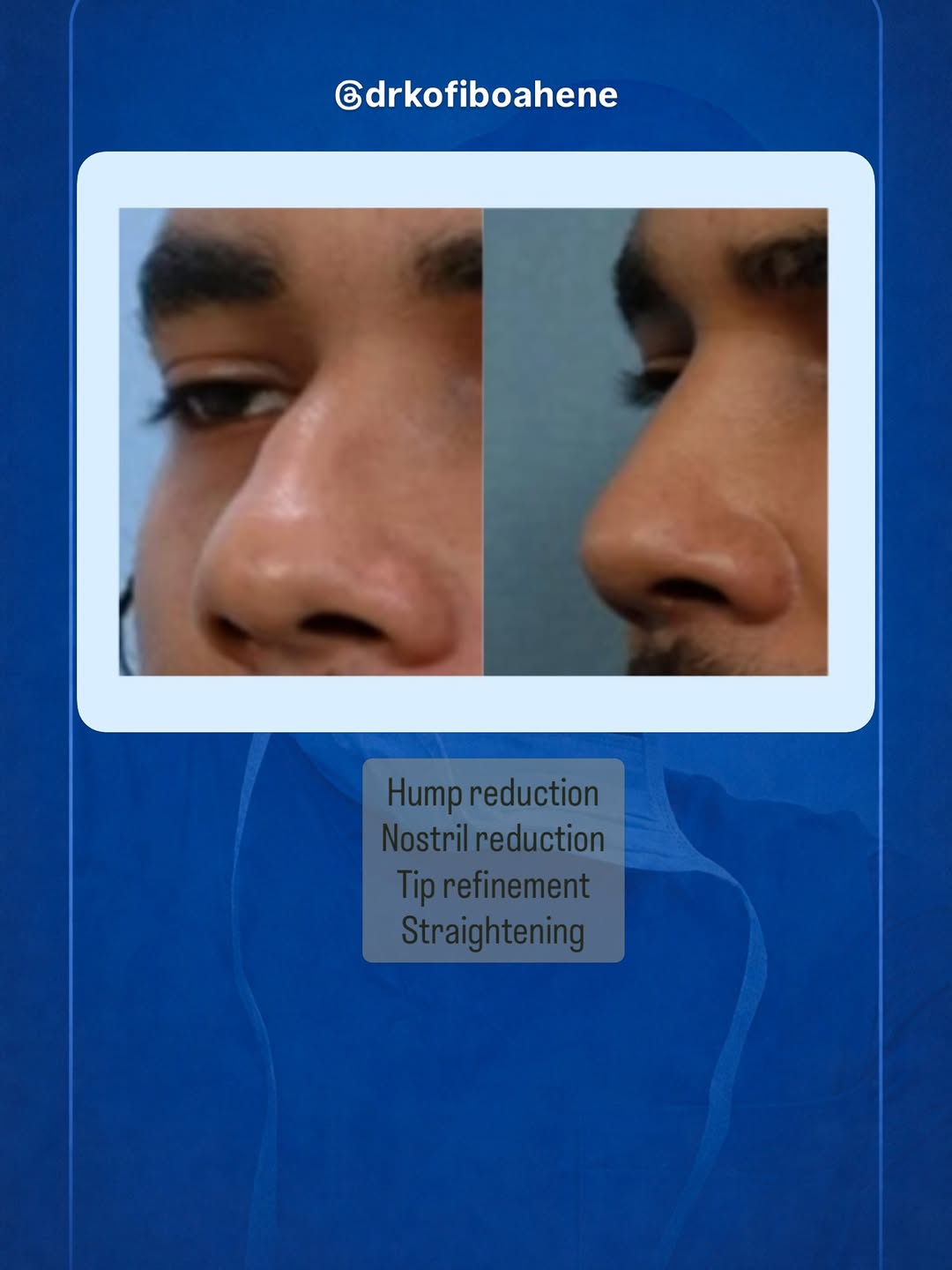 Instagram post by Dr. Shaun C. Desai: Little changes here and there. Nothing dramatic — just refined. Let’s talk. #Rhinoplasty #NoseJob #FacialHarmony #NaturalResults #SubtleRefi…