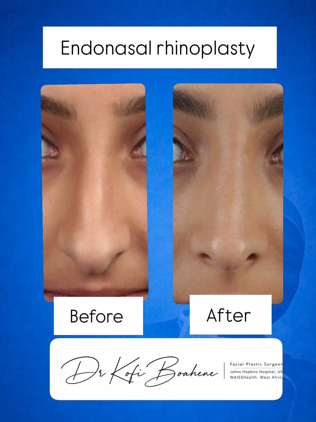 Instagram post by Dr. Shaun C. Desai: Can you spot the changes? 🧐 . Here is a front and profile breakdown of an endonasal rhinoplasty.The procedure focused on a smooth profile a…