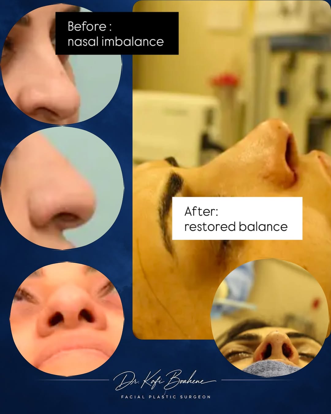 Instagram post by Dr. Shaun C. Desai: She did not want a different look but a face in balance. We refined her drooping profile and disproportionate tip using ethnically sensitive…