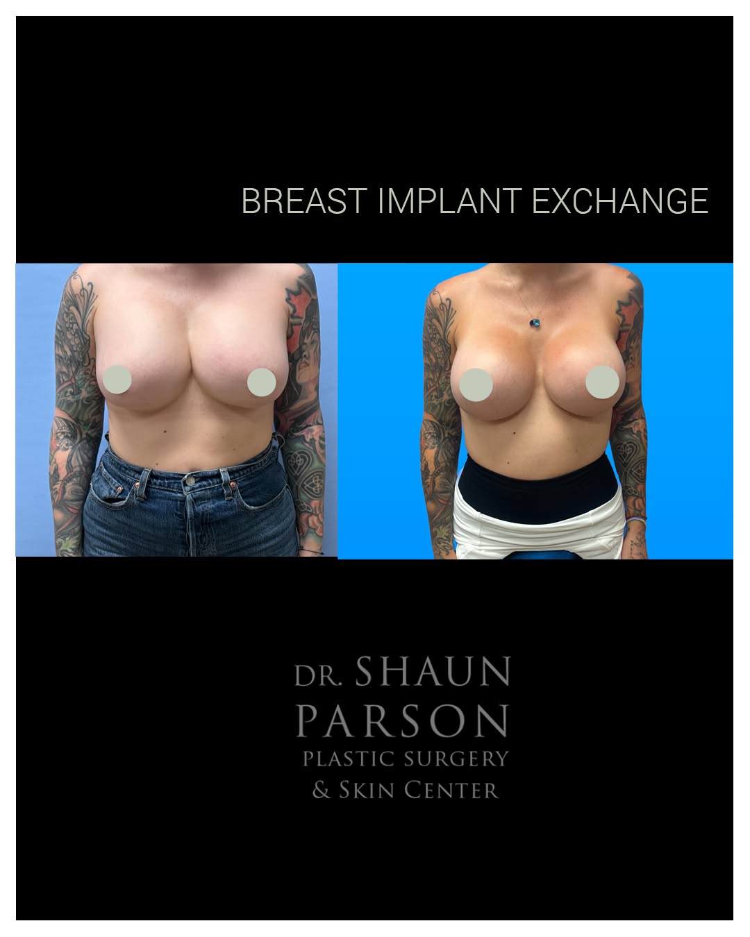 Instagram post by Dr. Shaun Parson: A fresh start after an unexpected implant rupture. ✨ After experiencing a breast implant rupture, this 37-year-old patient decided to underg…
