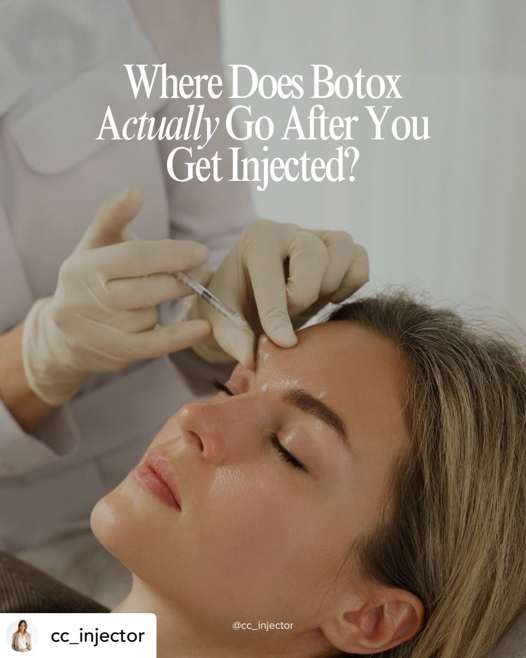 Instagram post by Dr. Shaun Parson: Reshare • @cc_injector So… where does Botox actually go after it’s injected? 👀💉 Botox works locally at the nerve endings near the targeted…
