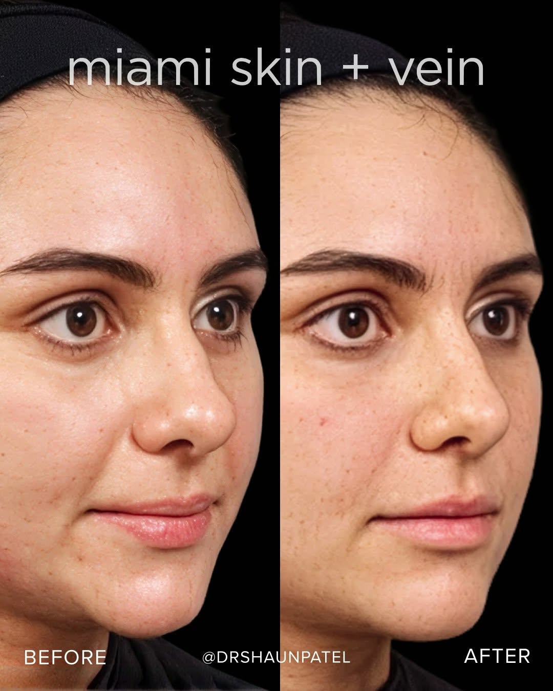 Instagram post by Dr. Shaun Patel: The nasolabial folds deepen with age as support beneath the skin shifts. Filler placed strategically restores that structure, easing the cre…