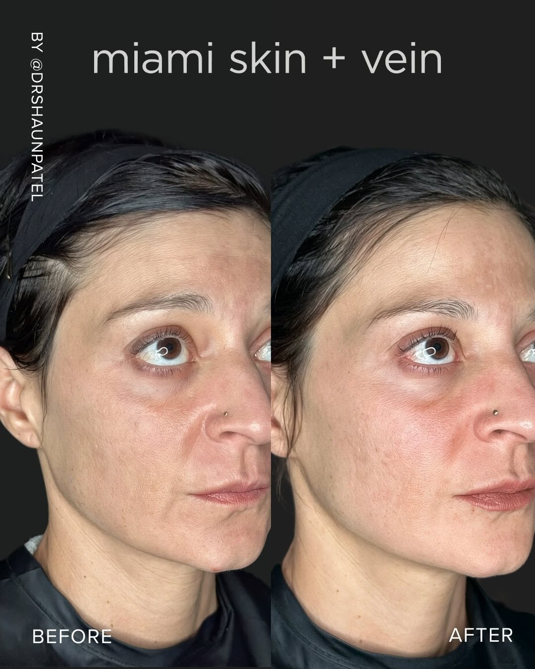 Instagram post by Dr. Shaun Patel: Not one area treated in isolation. A full-face approach built around how these features actually relate to each other. Dysport softened uppe…