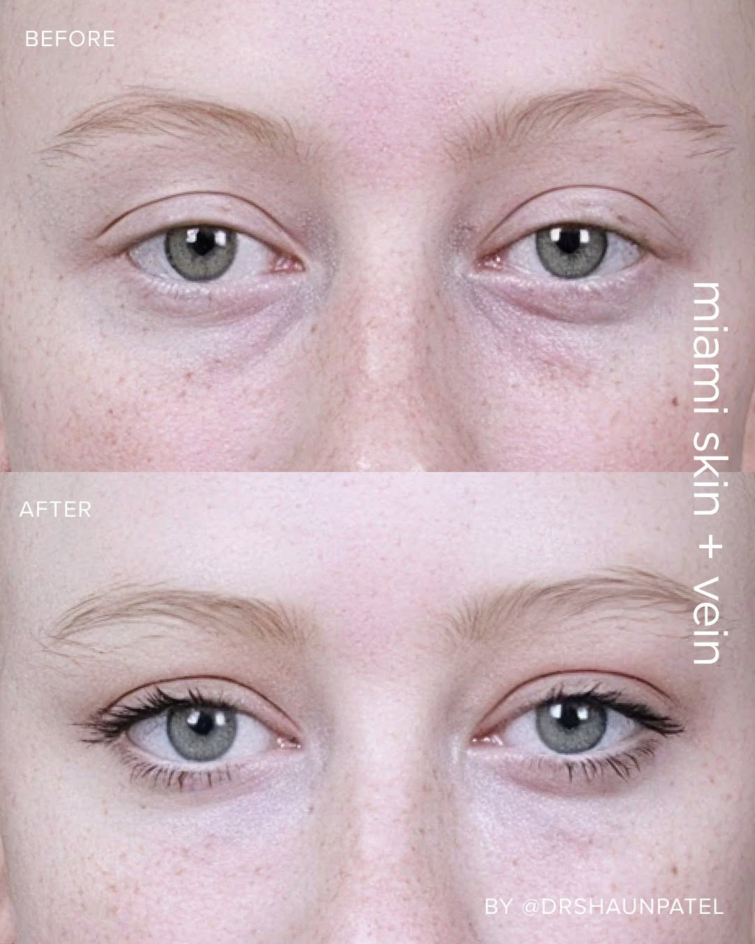 Instagram post by Dr. Shaun Patel: Hollowing beneath the eyes reads as tired even on a full night's sleep. Filler placed with precision restores that lost volume without chang…