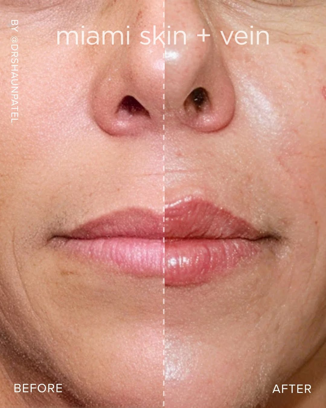 Instagram post by Dr. Shaun Patel: Volume and hydration, restored with precision 💉 The lip on the treated side shows more definition and a smoother border, without losing wha…