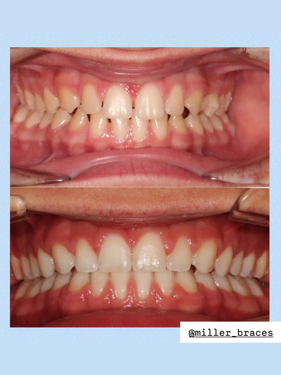 Instagram post by Dr. Shawn L. Miller, D: Bite corrected, spaces closed, midlines centered, NEW SMILE ACTIVATED😎😮💨🙌🏼 #millerbraces #millerortho #beforeandafter #newsmile #smile…