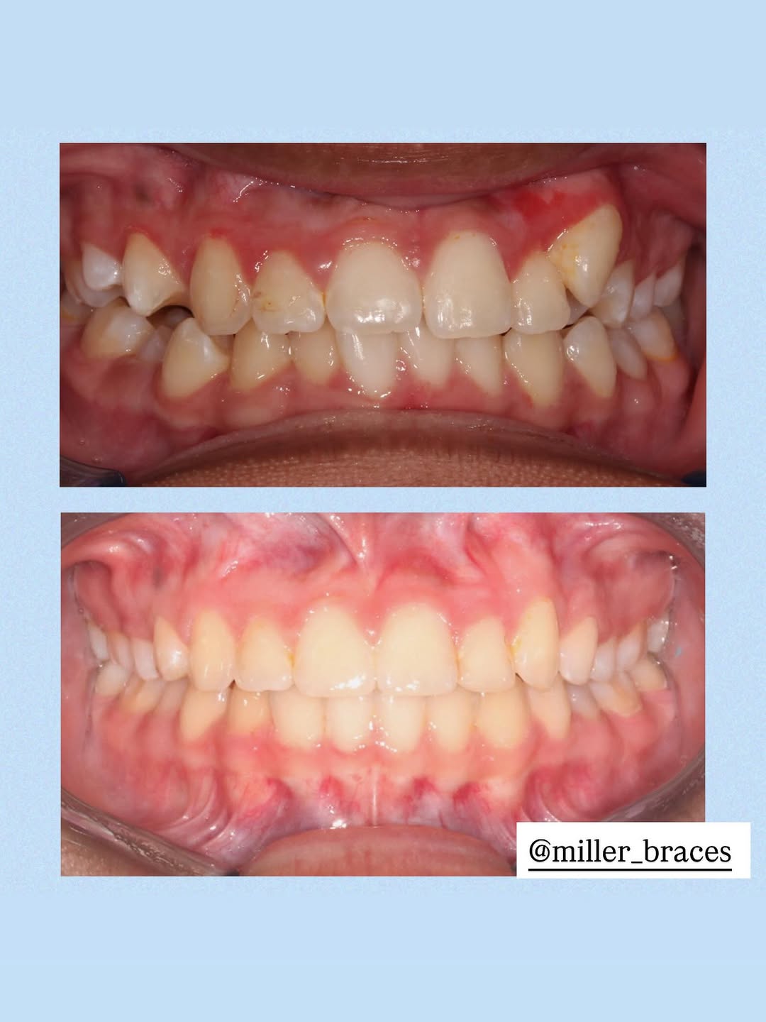 Instagram post by Dr. Shawn L. Miller, D: Check out this incredible before & after for our patient Mia! There is NO better feeling than having braces OFF & revealing a new smile!😄✨ …