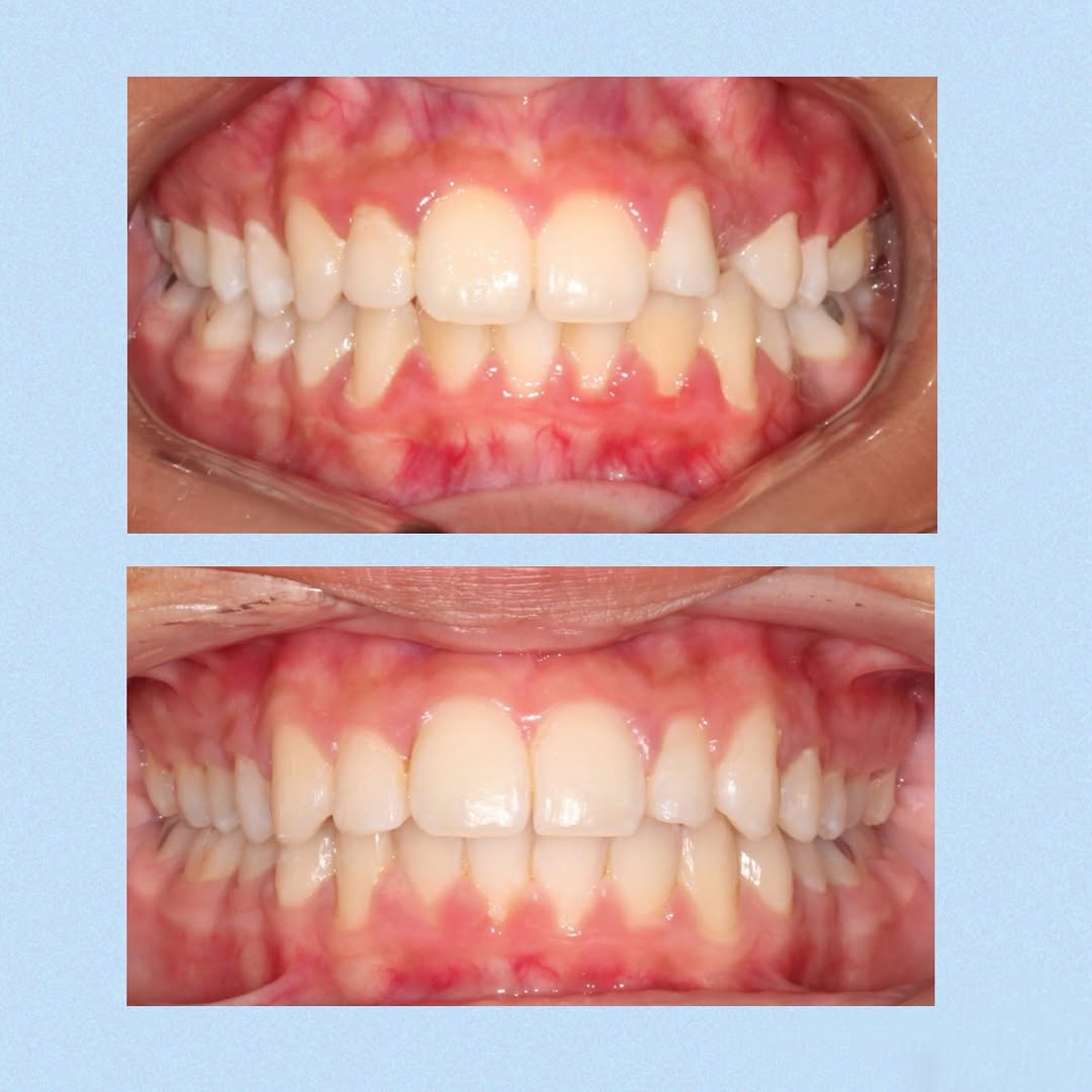 Instagram post by Dr. Shawn L. Miller, D: A beautiful result with the help of @wearelightforce ! The best braces in orthodontics✨ We’re so excited for our patient’s new smile today �…