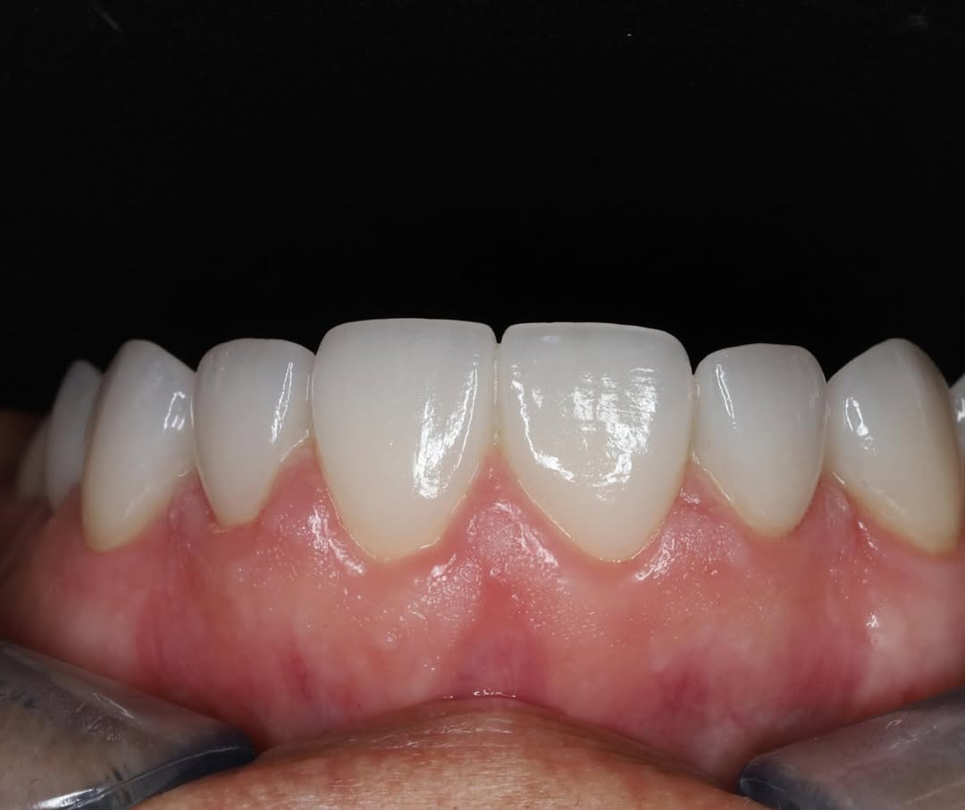 Instagram post by Dr. Shawn Matian, DDS: POV: Just finished up these veneers for my client.