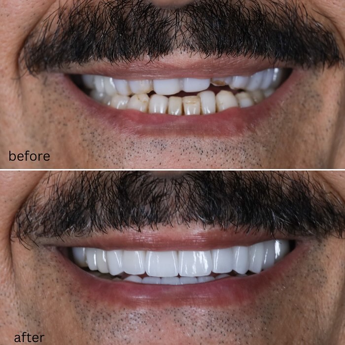 Instagram post by Dr. Shawn Matian, DDS: This gentleman came to see us and wanted us to address a loose implant crown. We briefly discussed a total refresh and initially he wasn't i…