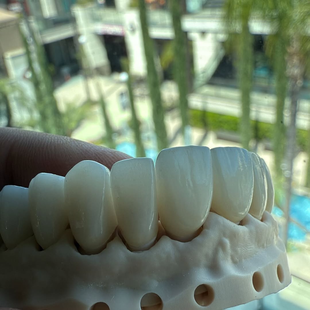 Instagram post by Dr. Shawn Matian, DDS: Details are everything #veneers #dentist