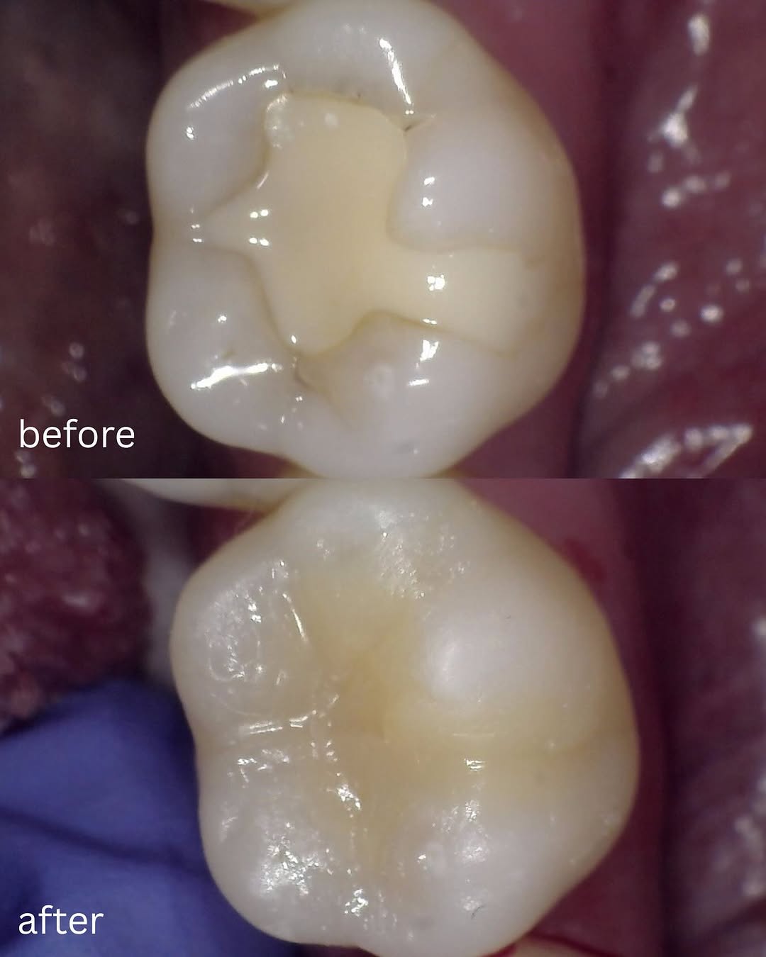 Instagram post by Dr. Shawn Matian, DDS: Dentists (myself included) usually just post dramatic makeovers. But cosmetic dentistry is also things like this. Doing a filling that mimic…