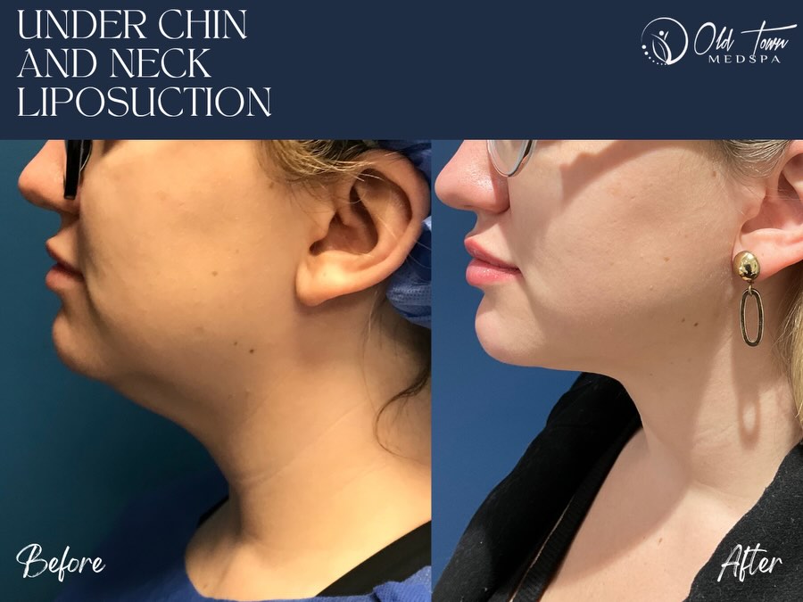 Instagram post by Dr. Shazel Gharbi: This patient came to Old Town Med Spa for a more contoured silhouette with liposuction and Renuvion skin tightening. Every body is different…