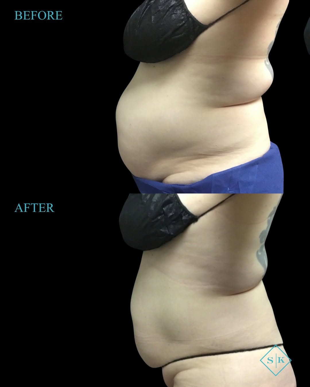 Instagram post by Dr. Sheena Kong: Results after 3 rounds of CoolSculpting! 👏 This before + after shows the power of a customized treatment plan designed to target stubborn p…