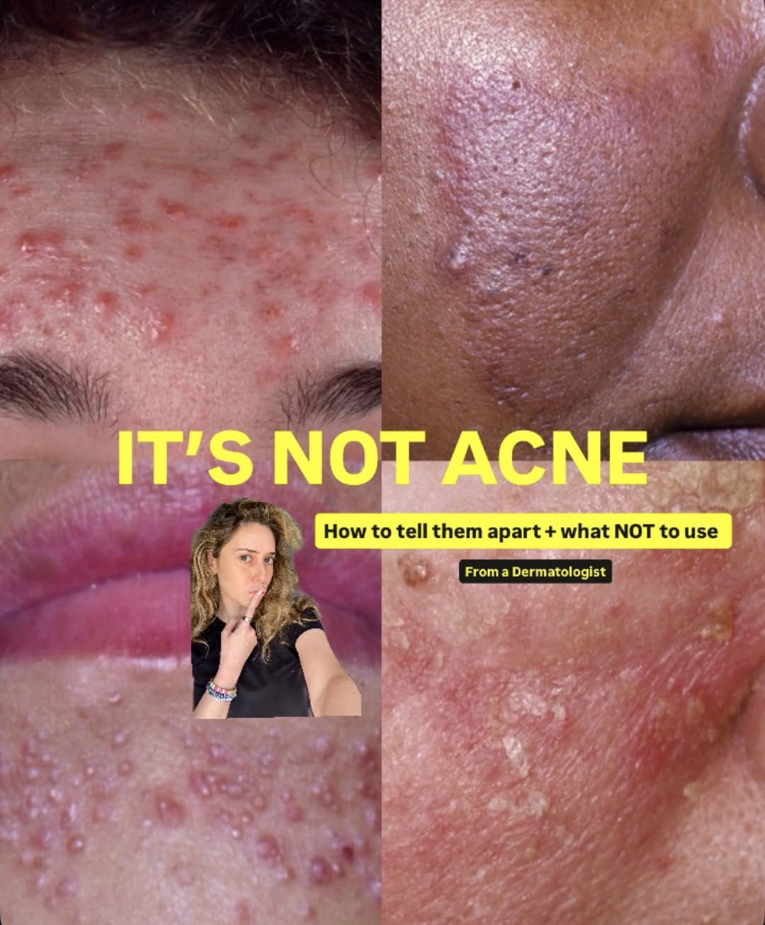 Instagram post by Dr. Shereene Idriss: SAVE THIS: Acne, Perioral Dermatitis, Rosacea and Seborrheic Dermatitis 4 rashes that all look like alike but they’re not and should be trea…